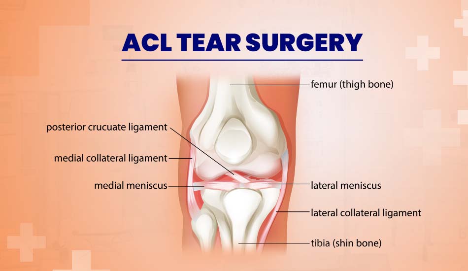 ACL Tear Surgery Explained: Steps, Recovery, and Success Stories